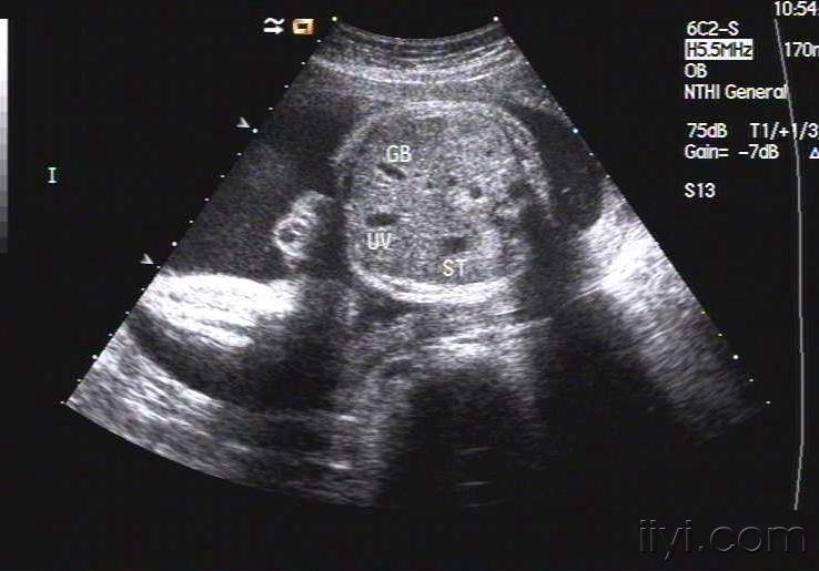 宫内早孕双环征超声图像_全前脑超声图像_脑ct图像